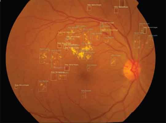 AI Solution By Intel an Aid to Reduce Diabetic Vision Loss